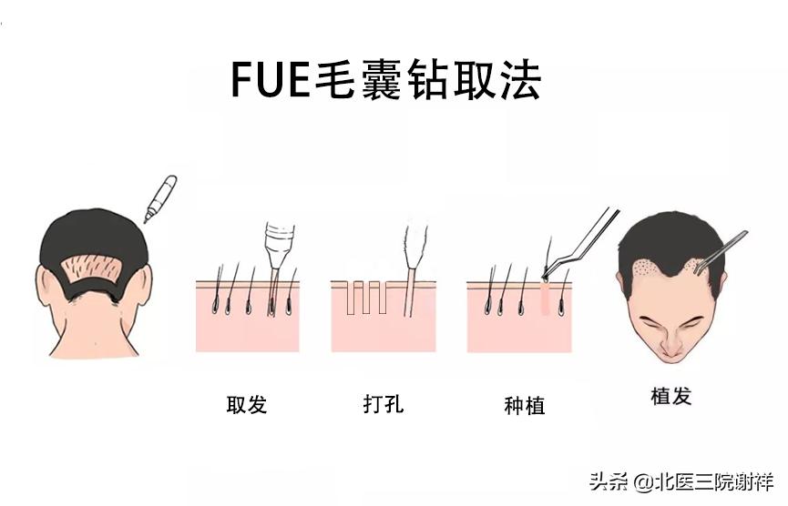 想要远离脱发远离八大误区,预防脂溢性脱发应避开这两大误区