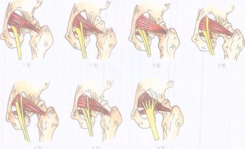 屁股痛、腿麻，有块肌肉受伤了