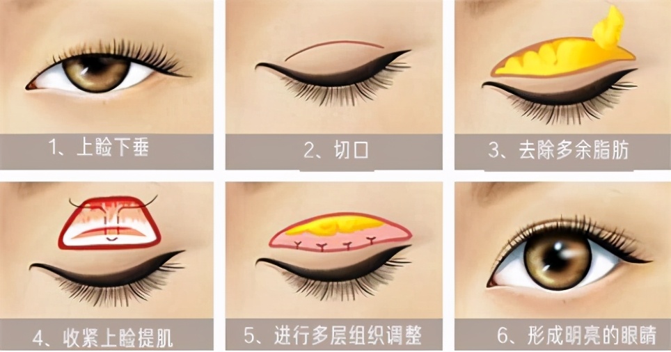 可以只做泪沟不做眼袋吗,上睑下垂矫正不做双眼皮可以吗