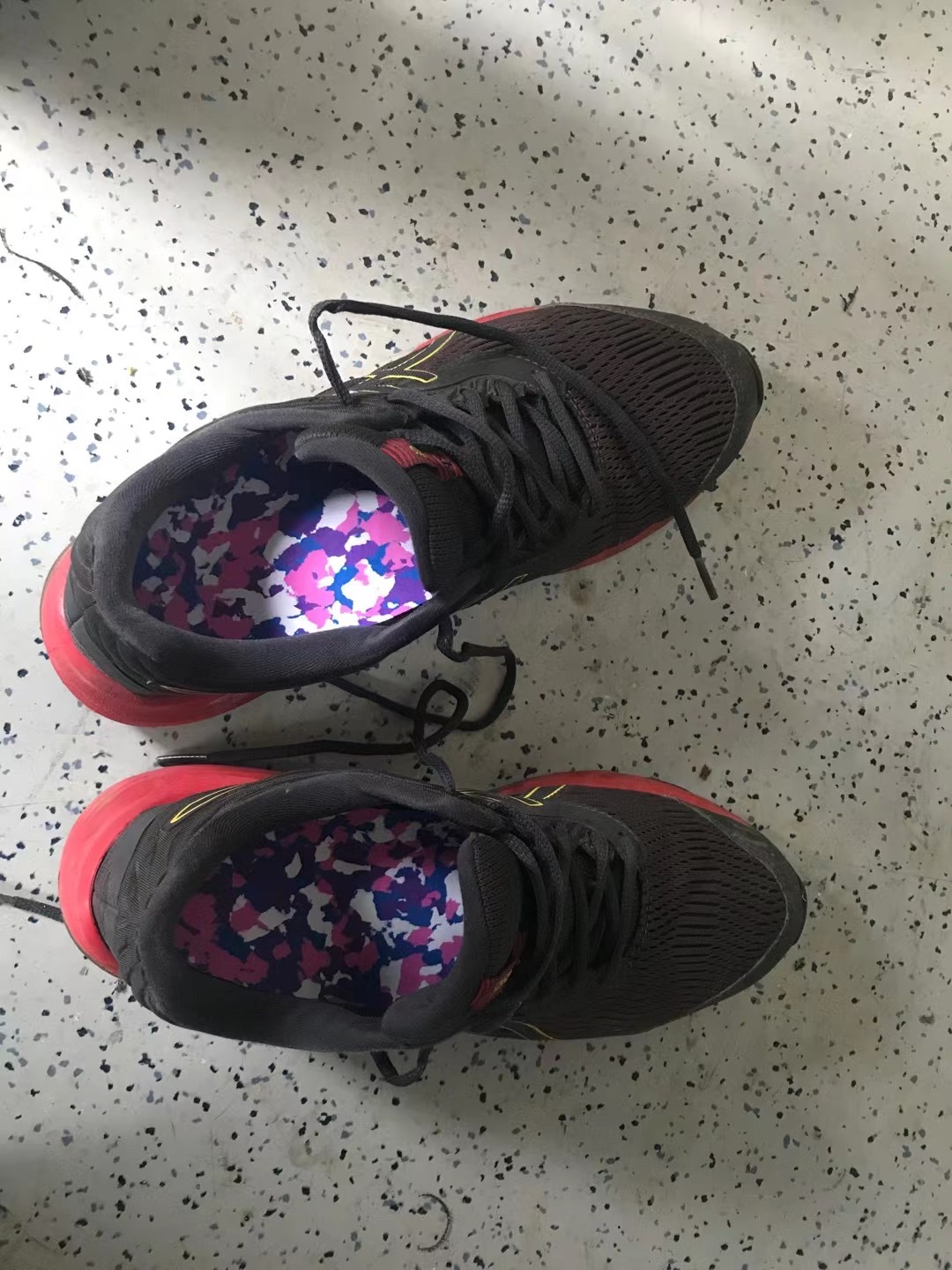 拇外翻微创手术的全过程,医生自己给自己做拇外翻手术