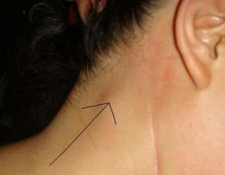 脖子上的“小肿块”——淋巴结肿大怎么办？