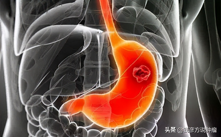 胃印戒细胞癌做手术后还会复发么,胃印戒细胞癌早期没化疗可以吗