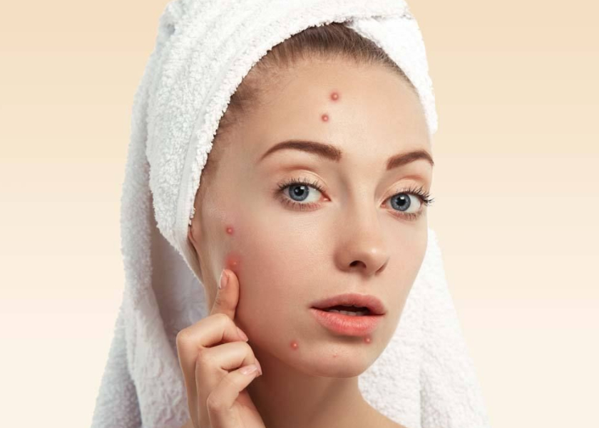 怎样祛痘痘最快最有效祛痘产品,如何祛痘并且不再长痘