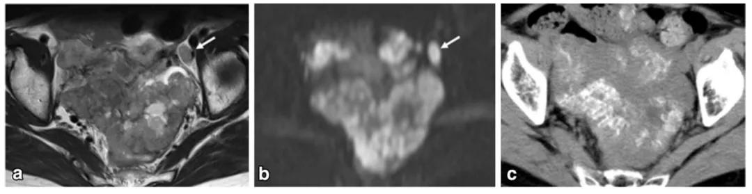 卵巢实性为主肿瘤，这13种你都想到了吗？
