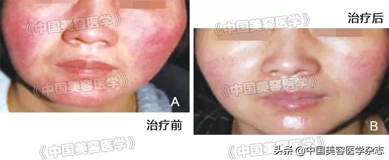 激素依赖性皮炎用薇诺娜生物膜,医用愈肤生物膜可以和vc一起用吗