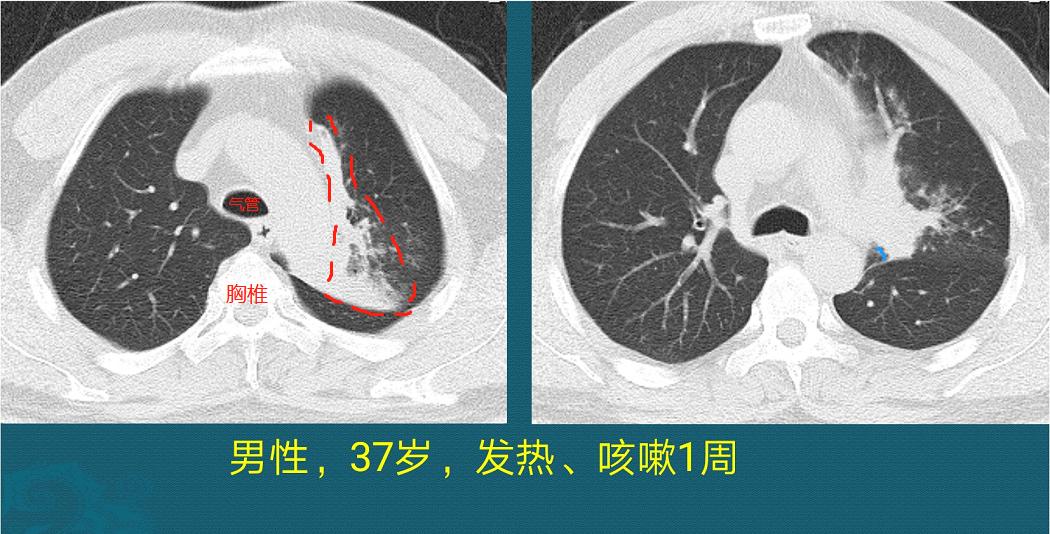 怎样确定肺鳞癌生长速度过快,肺鳞癌肿瘤生长速度