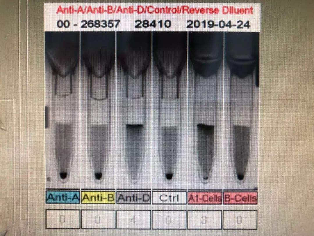 孟买血型和rh血型哪种更稀有,世界上稀有的10大血型排名