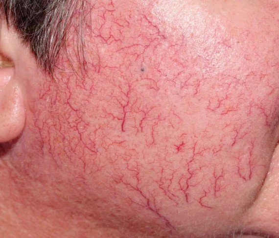 眼睛红有血丝怎么治疗,如何治红血丝