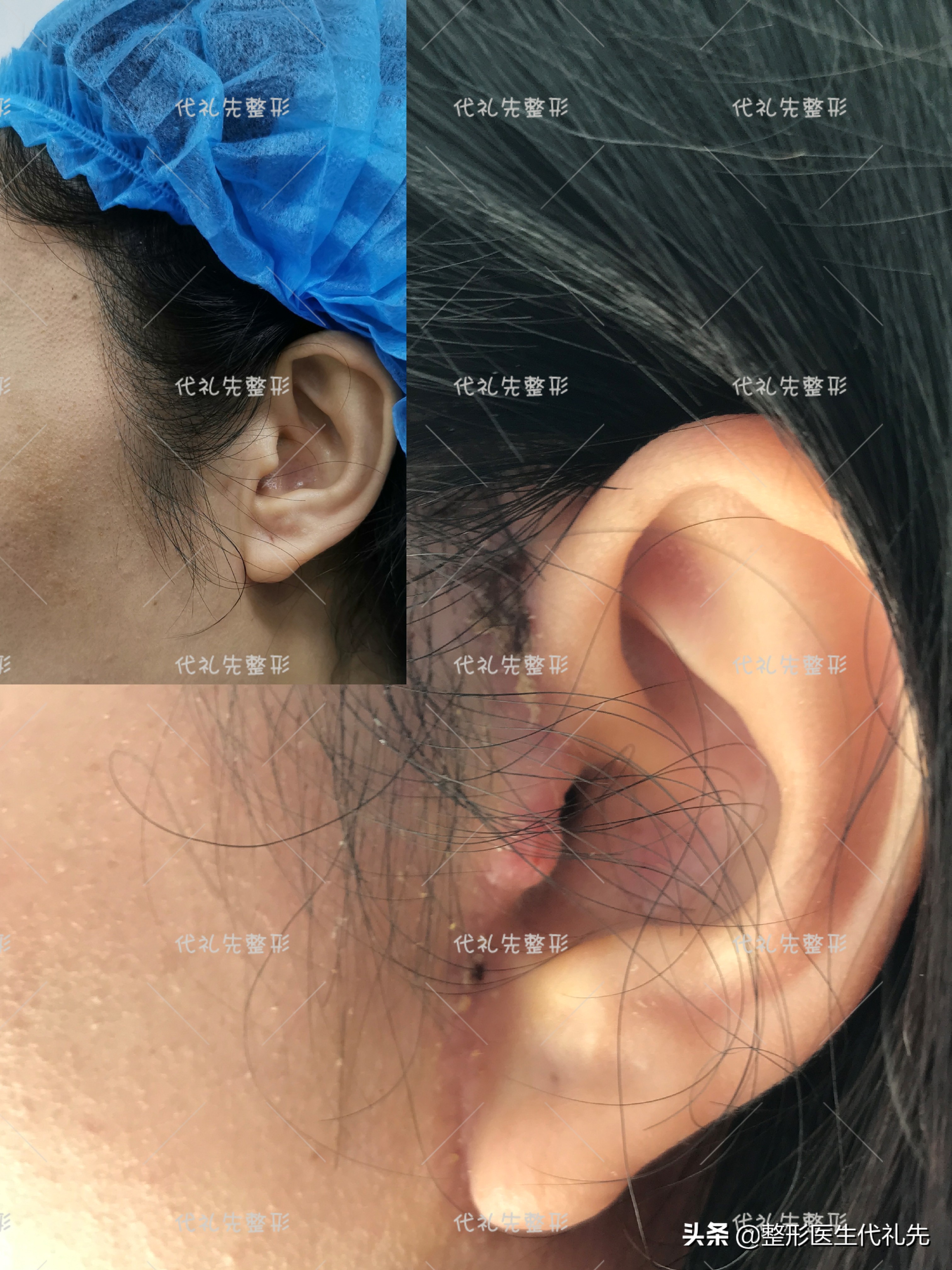 smas拉皮手术,smas大拉皮手术适合多大年龄