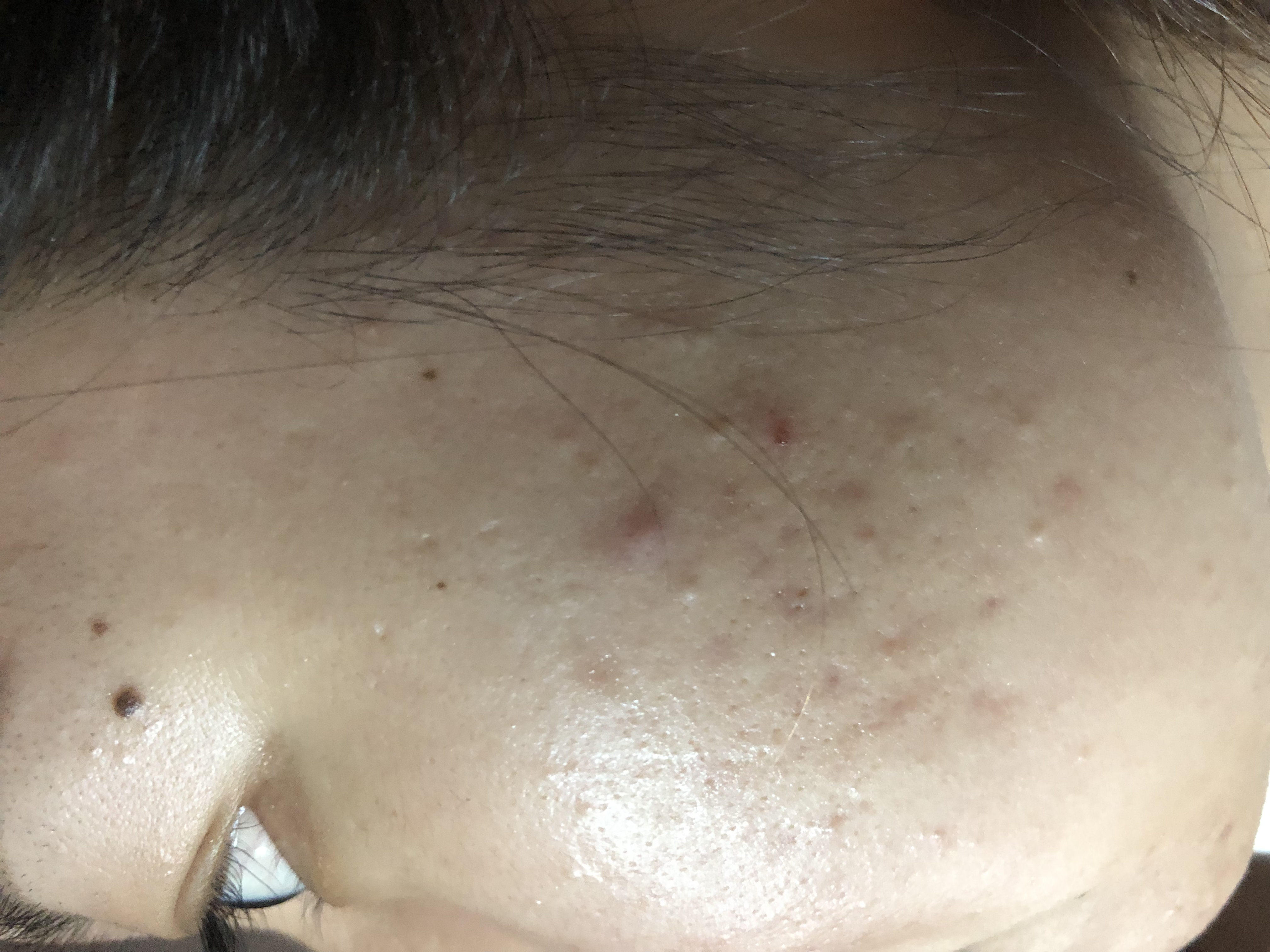 长痘烂脸期怎么修复,神仙水和海蓝之谜精华