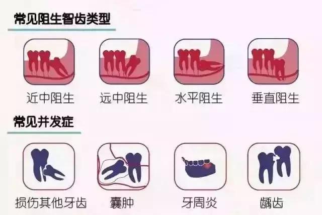 智齿疼是拔掉好还是治疗好,智齿疼是拔掉还是治疗