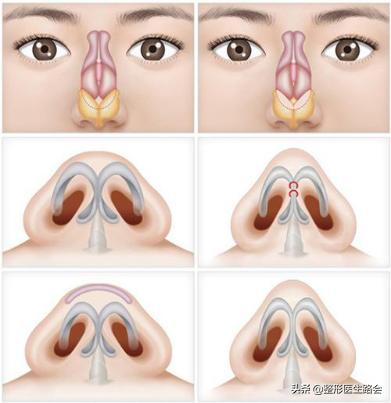 鼻翼缩小外切好吗,鼻翼缩小外切还是内切效果好