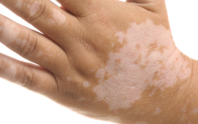 白癜风治疗过程,患白癜风怎么办的视频