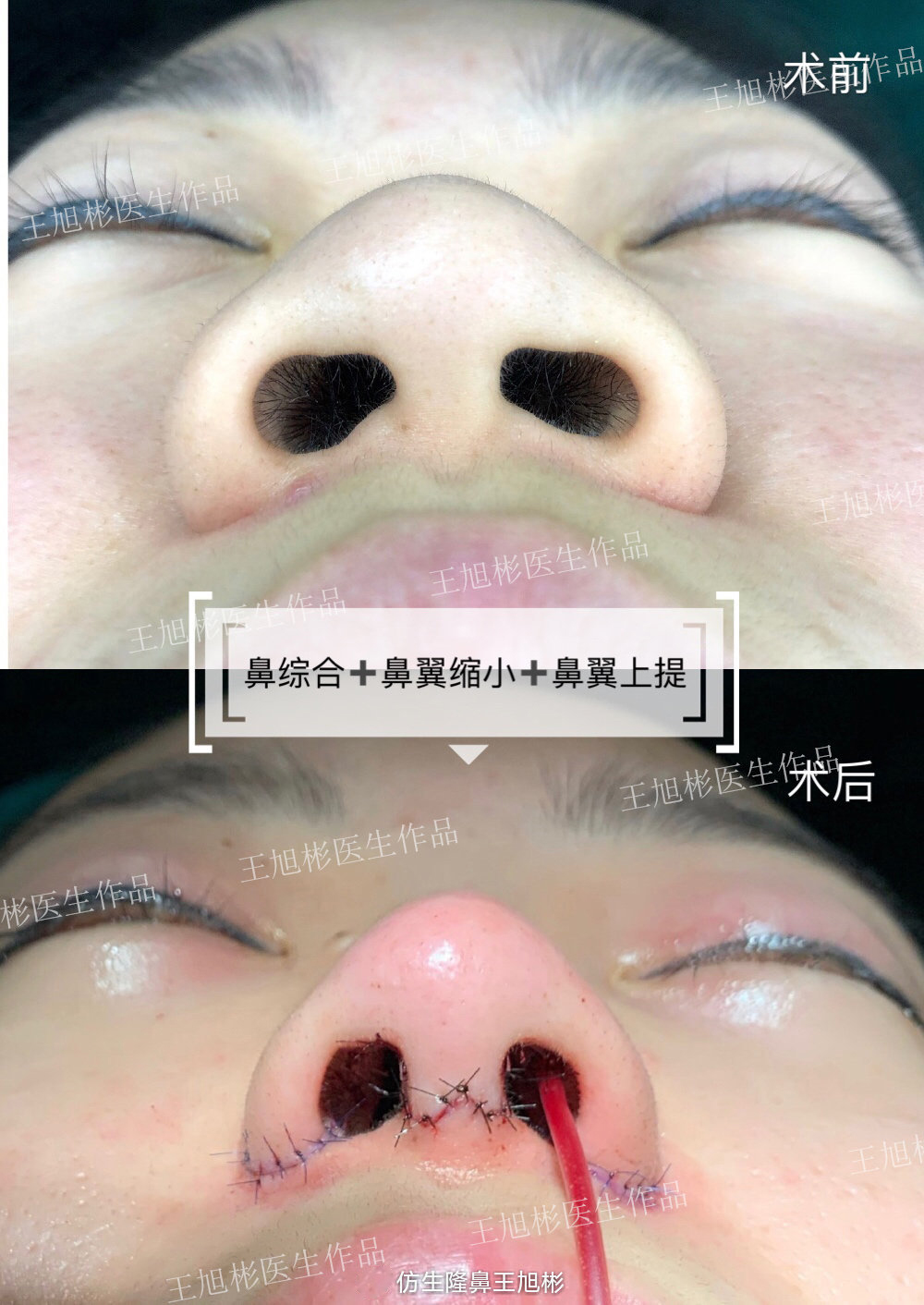 缩鼻翼可以改善鼻翼下垂吗,鼻翼肥大之鼻翼缩小术你见过吗