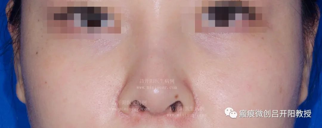 强脉冲激光治疗脸部视频,点阵激光嫩肤