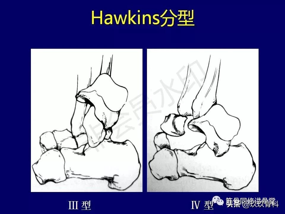 距骨骨折的治疗原则,距骨骨折如何调理