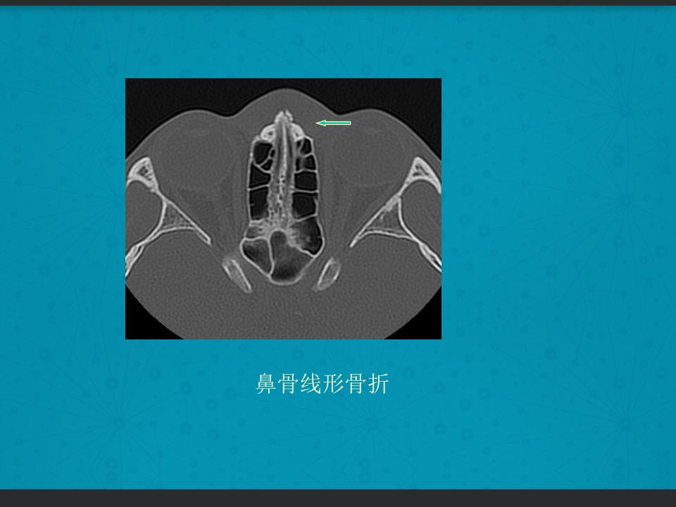 鼻骨骨折复位全过程,诊断证明鼻骨骨折问号是什么意思