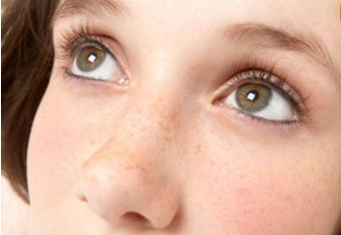 产后长斑很烦恼,皮肤有斑还有痘应该先治疗什么呢