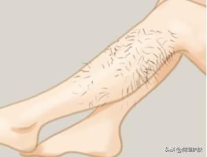 激光脱毛能永久吗腋下,激光脱毛能永久吗知乎