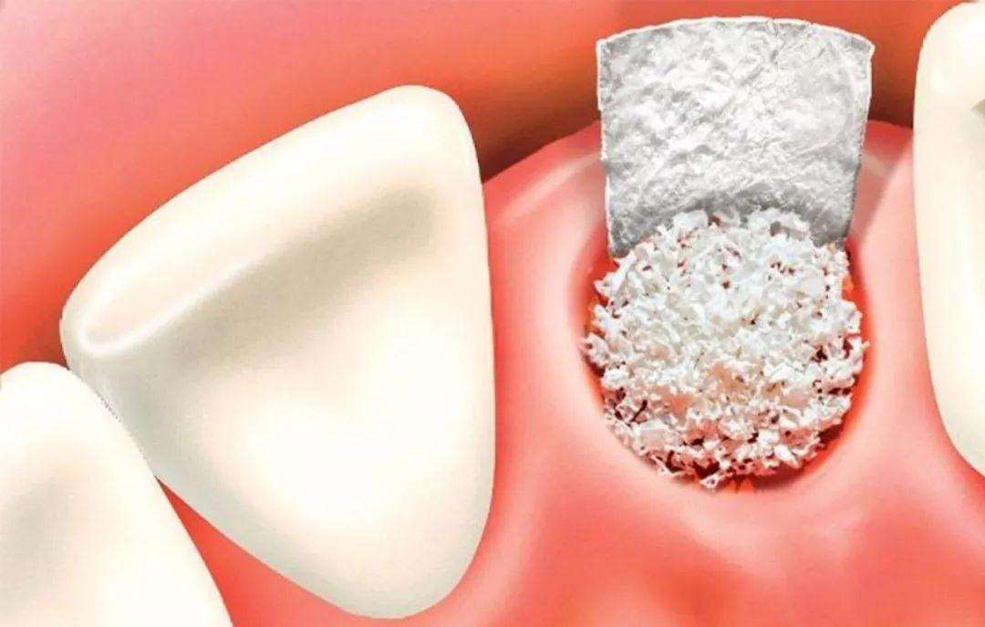 种植牙牙槽骨很薄怎么办,牙槽骨浅可以做种植牙吗