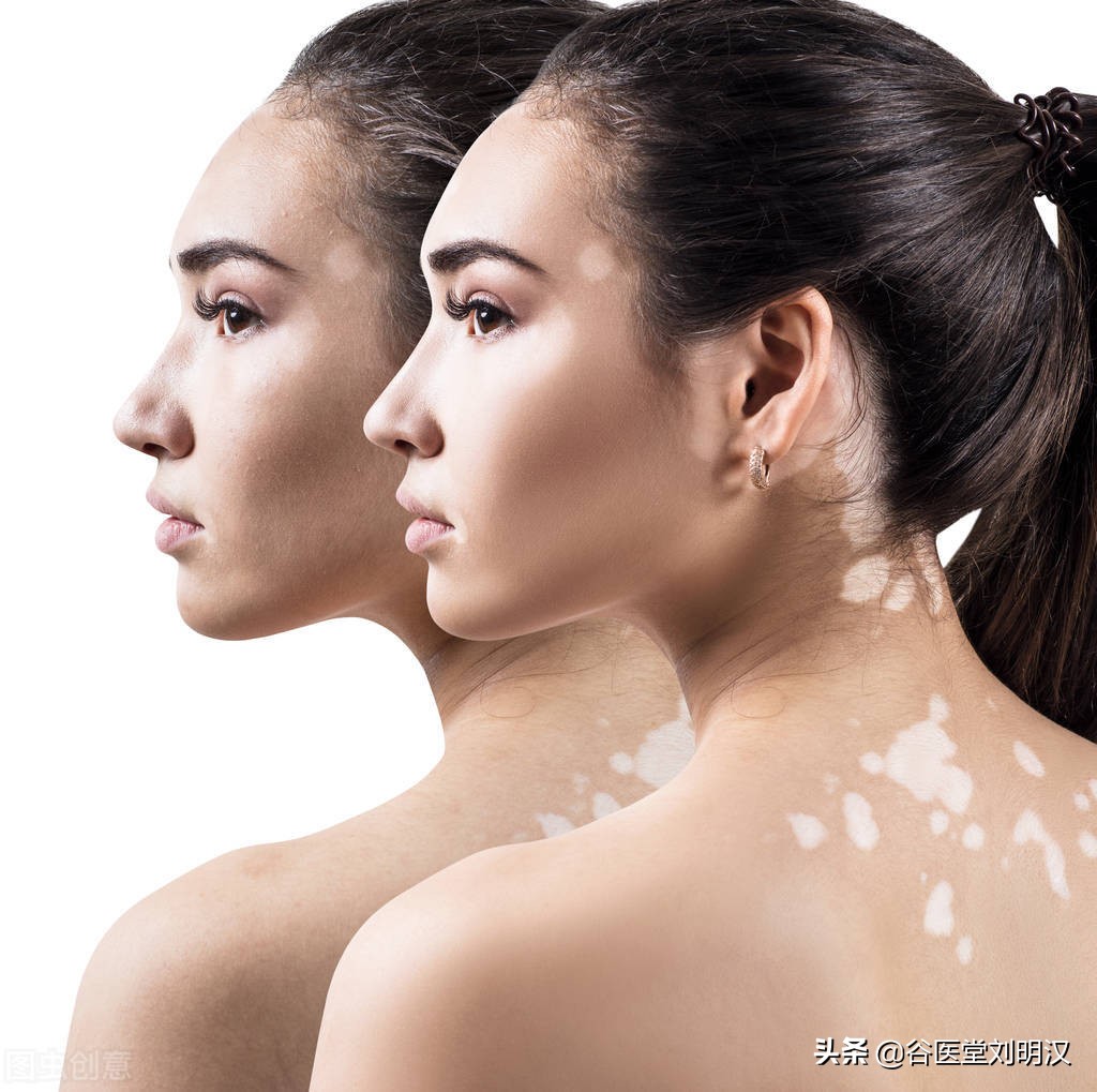 哪些方法能辅助治疗白癜风,白癜风患者如何正确应对