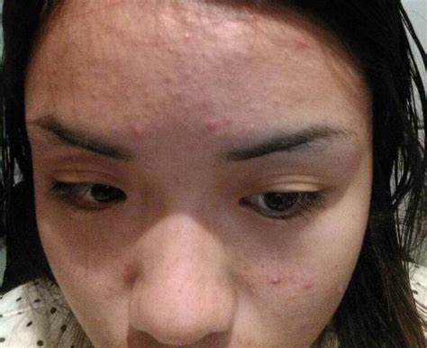 夏天长痘痘了用什么洗,夏天祛痘