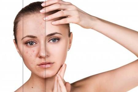 青春期额头长痘痘怎么消除女生,额头太阳穴长痘痘什么原因