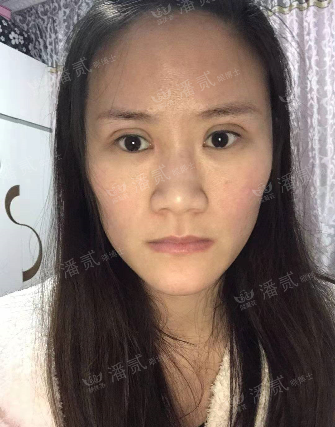 上海马大哈姑娘，稀里糊涂整了容，术后就一个字：丑