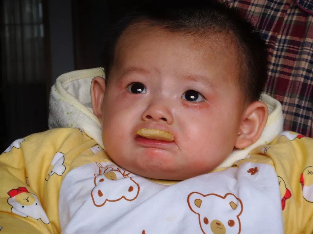 猫奶癣和猫癣分辨,奶藓和猫藓的区别有哪些