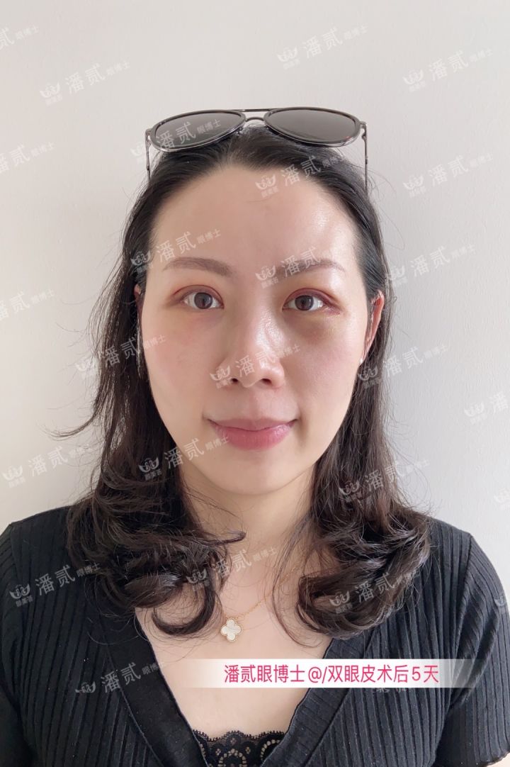 原来双眼皮不好看有必要继续割吗,割双眼皮是不是越修复越难看