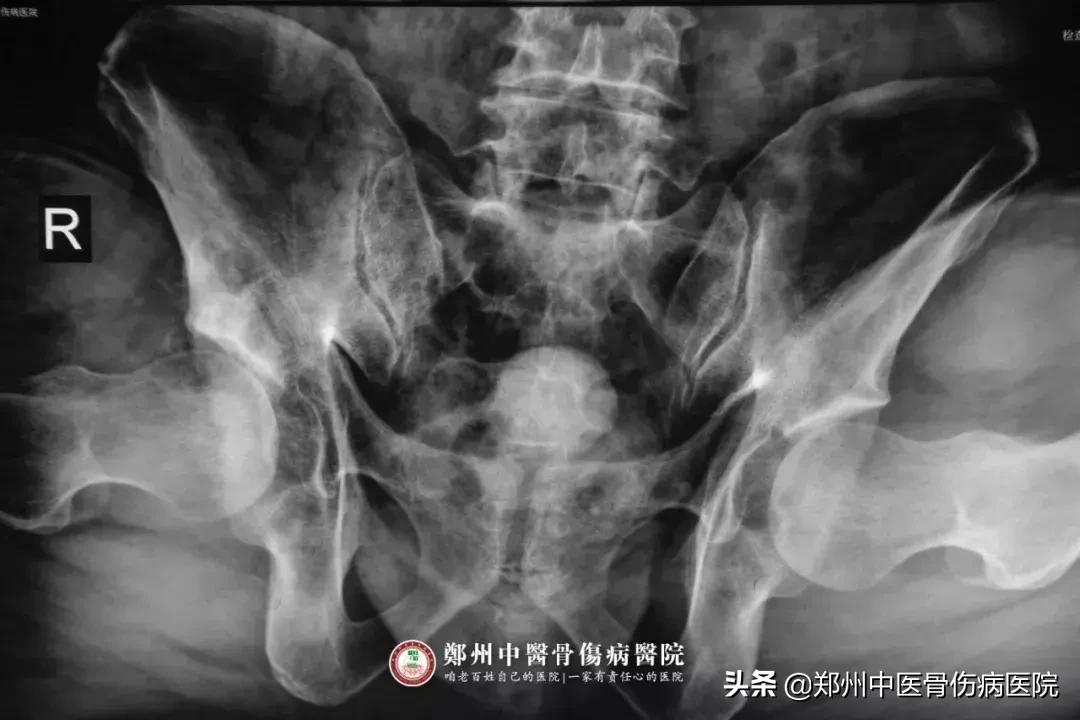 股骨头坏死换全髋康复后注意哪些,股骨头坏死手术置换多久可以康复