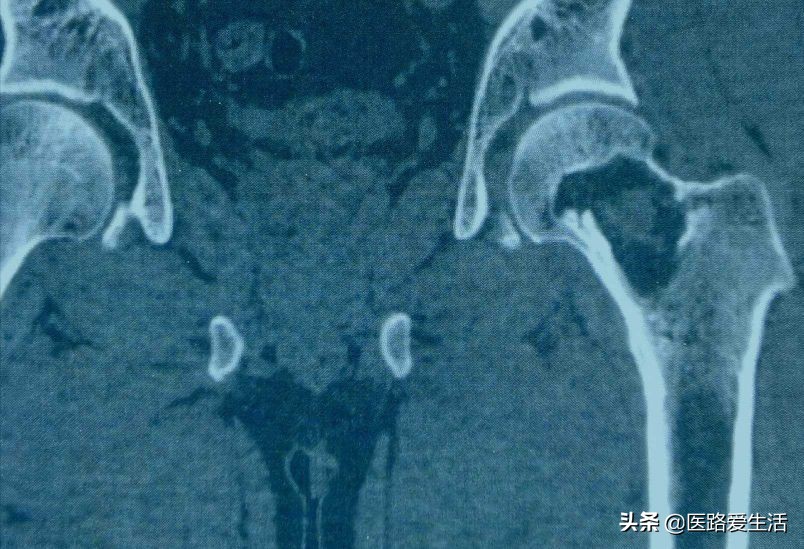 骨肿瘤能彻底治愈吗,骨肿瘤良性和恶性影像区别