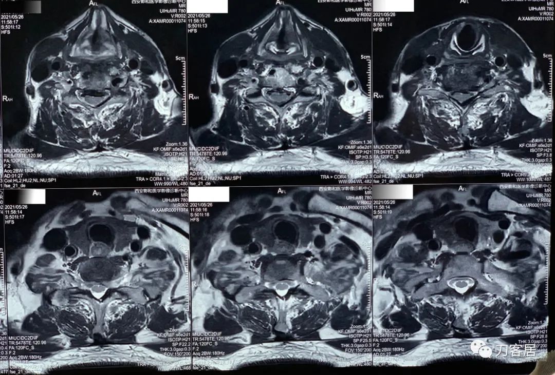 颈椎病椎间盘突出医生说先不手术,颈椎3-7节椎间盘突出怎么治疗