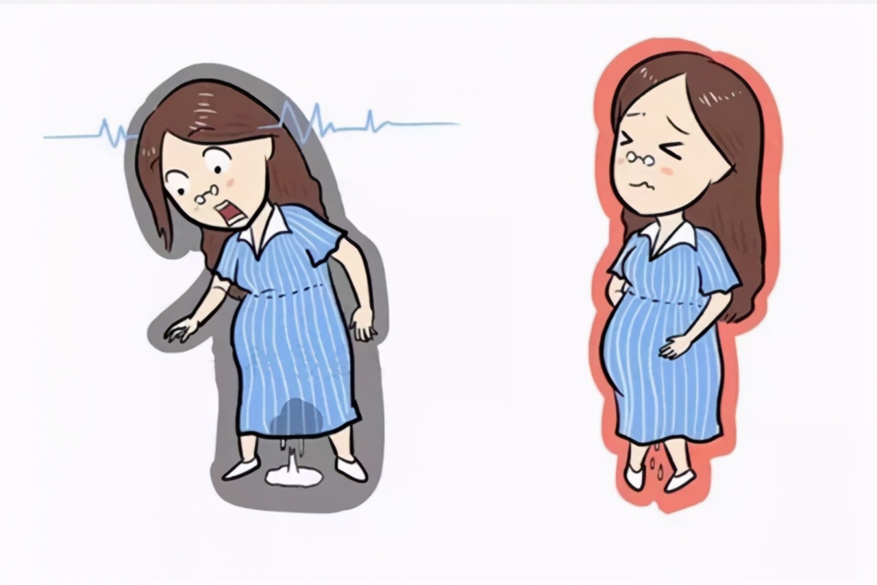 孕妇漏尿解决办法,孕妇漏尿有什么办法解决