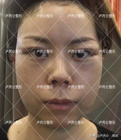 拉皮手术的后遗症有哪些,拉皮手术后易出现哪些后遗症