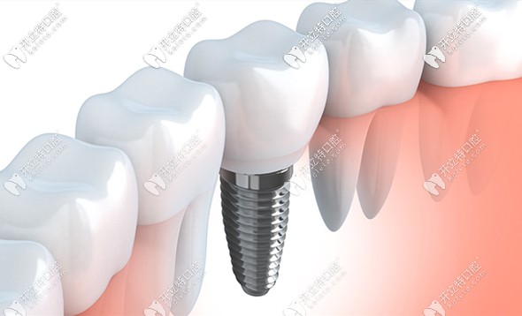 苏州口腔医院种牙价目表,2022苏州种植牙齿价格