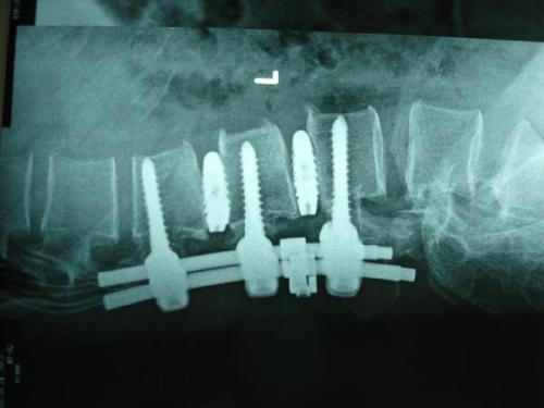 椎间盘突出预防和缓解,极外侧型椎间盘突出