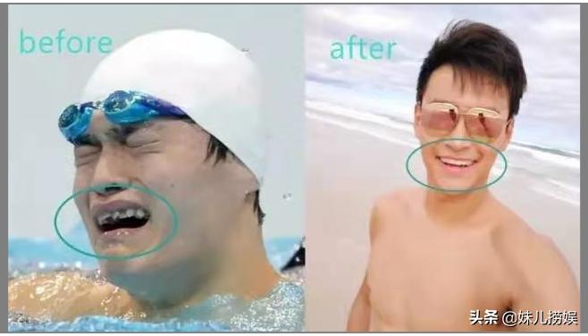 烤瓷牙美白注意事项,烤瓷牙选错颜色有点黄如何美白