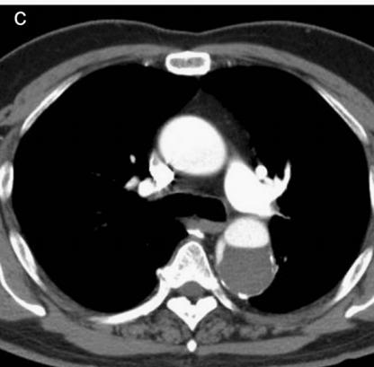 肠系膜上动脉夹层,心脏动脉夹层破裂