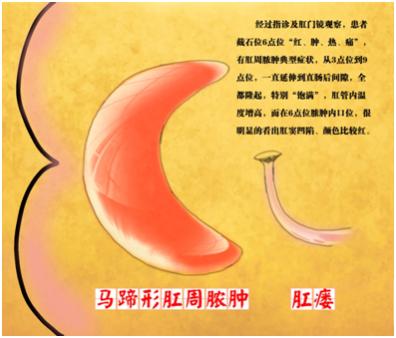 肛周脓肿的预防和治疗方法,肛周脓肿的治疗原则和注意事项