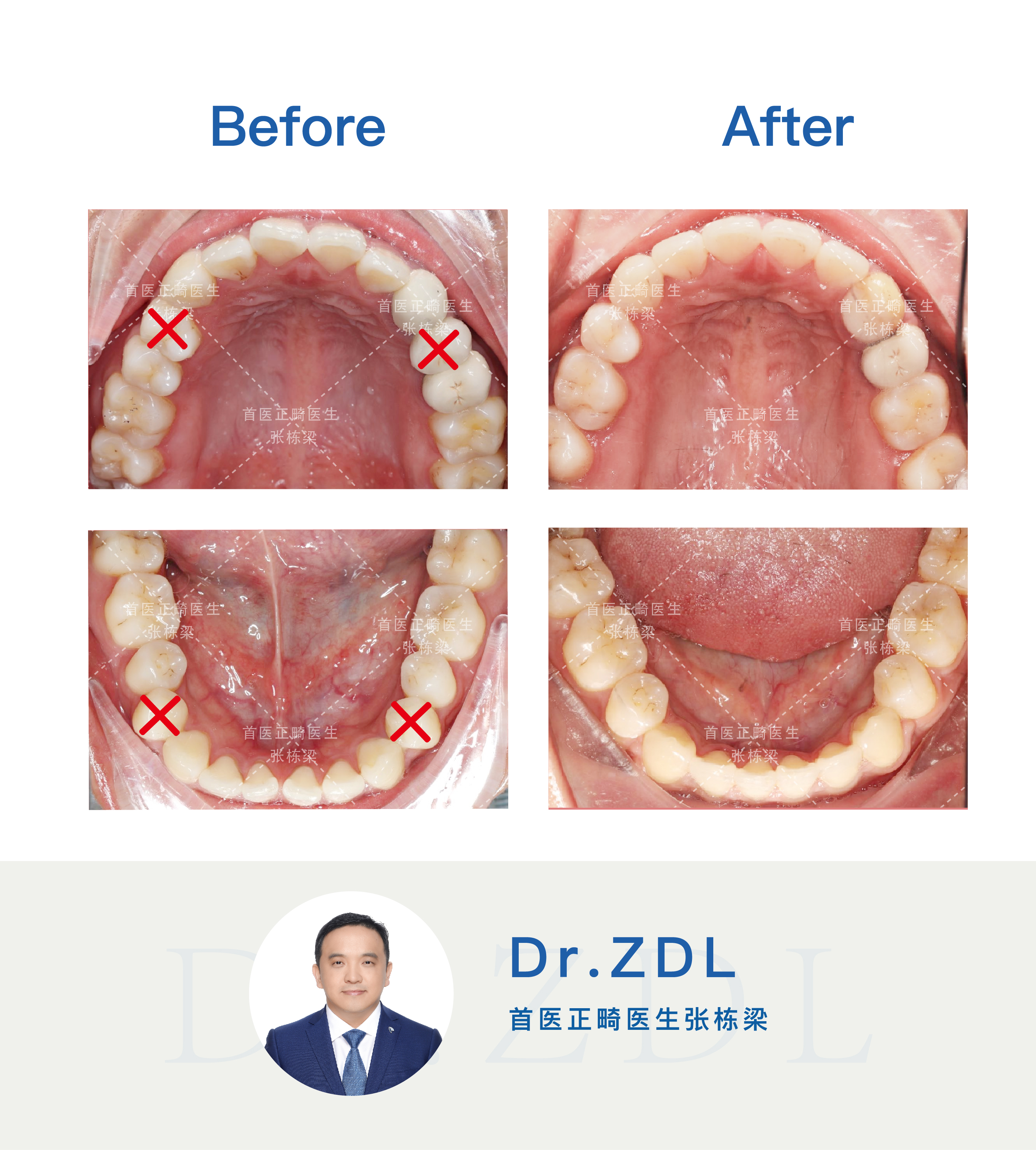 做了烤瓷桥还能正颌吗,做了烤瓷桥还能做钢牙吗
