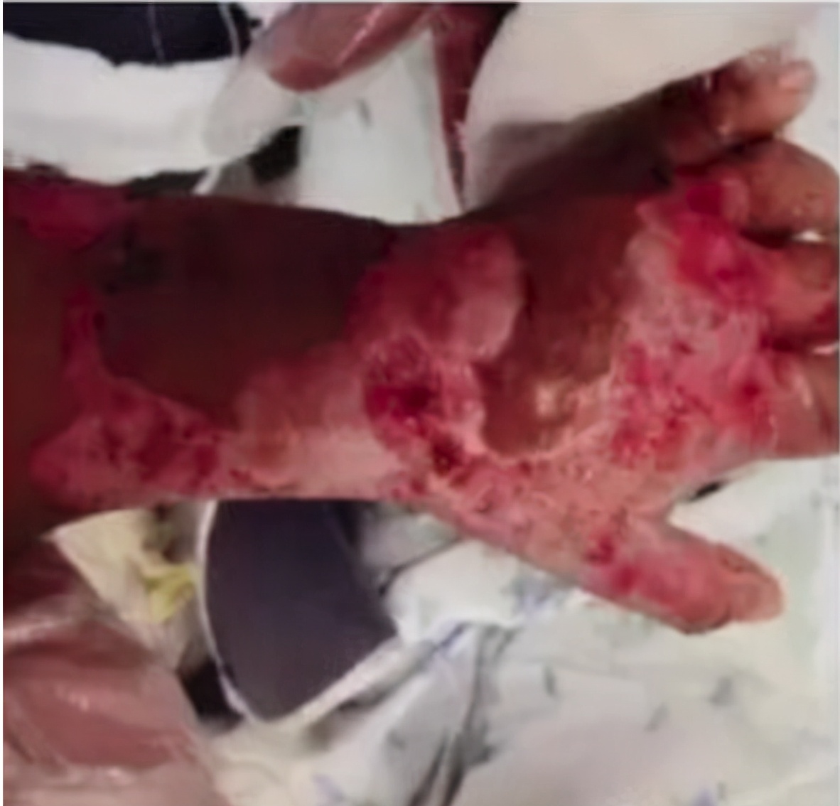 7岁女童被虐待,6岁女童遭亲妈残忍虐待致残