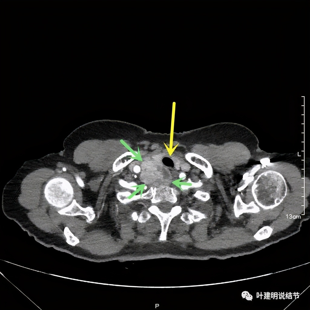 胸部高分辨ct检查注意事项,胸部ct扫描有没有危害