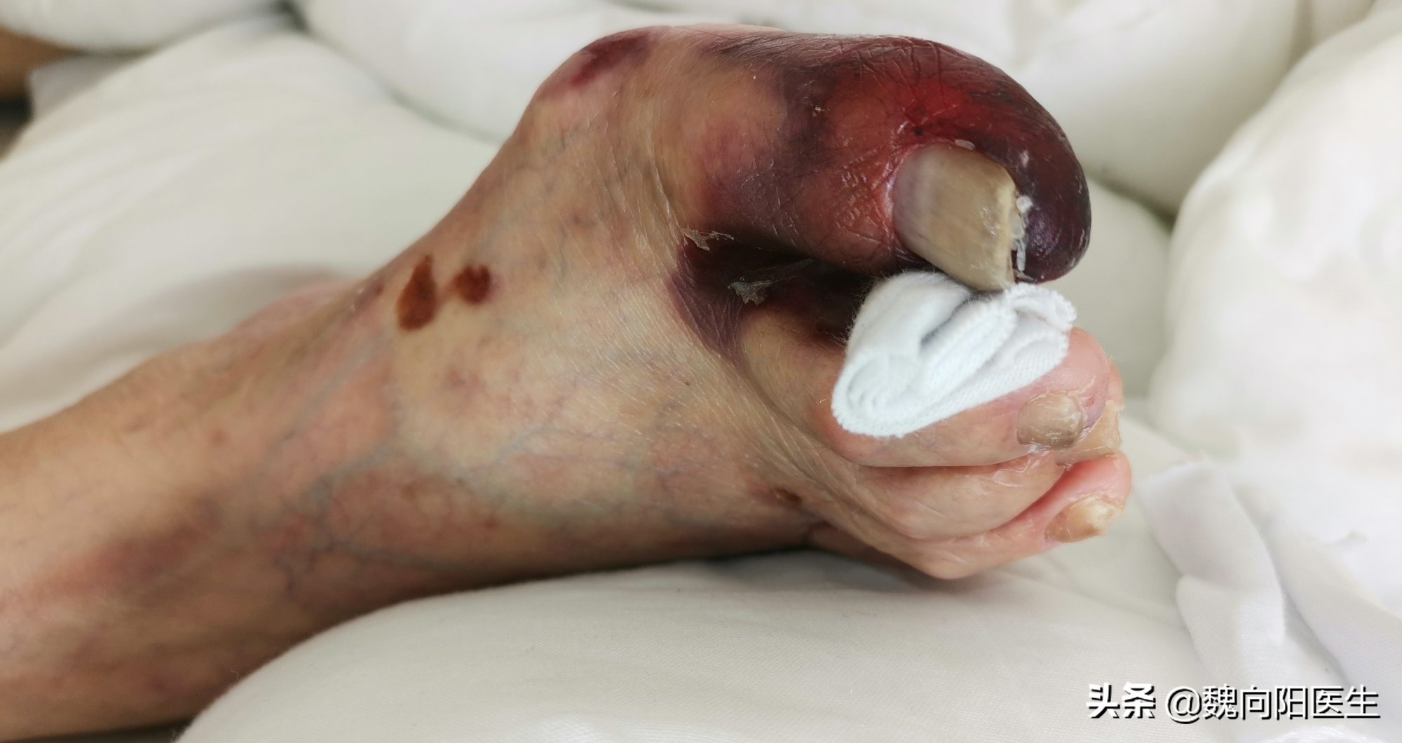 脚趾是平的是糖尿病足么,糖尿病足脚趾甲会什么样