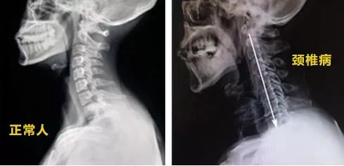 9岁小学生颈椎弧度变直,九岁颈椎变直