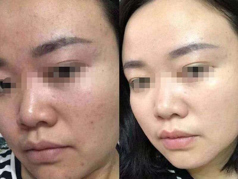 热带小黑虫怎么预防叮咬,弥勒小黑虫叮了起水泡