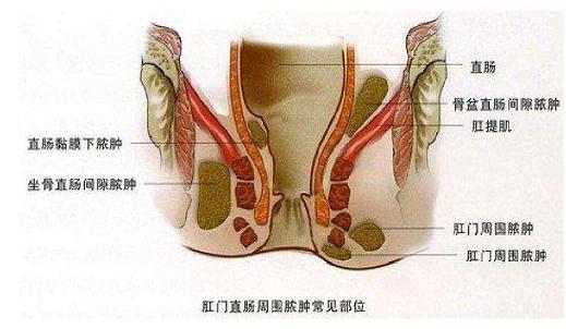 肛周脓肿是什么级别的手术,肛周脓肿快速消除小妙招