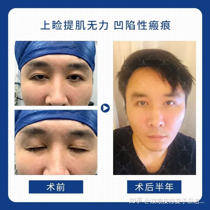 双眼皮割毁了可以修复吗,切开双眼皮失败可以用埋线修复吗