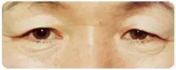 肿眼泡是什么原因啊,肿眼泡怎么贴双眼皮