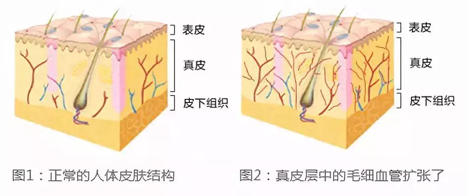 敏感肌红血丝屏障受损如何修复,敏感肌肤改善红血丝最好的方法